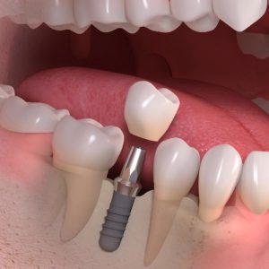 Dental Implants in Sydney