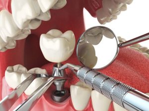 Tooth implant pain in Sydney